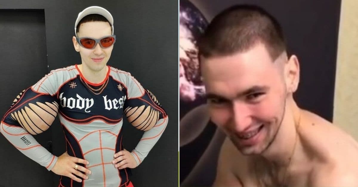 Bodybuilder 'Popeye' Shows Off His Biceps After Surgery Removed Dead Muscles